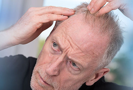 Senior man concerned by hair loss