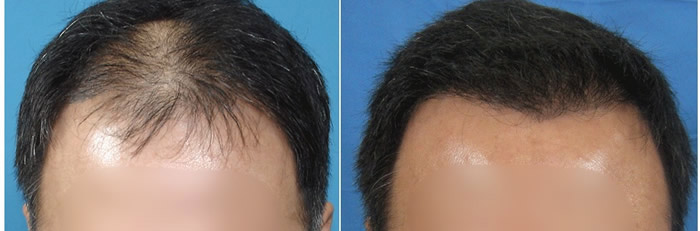 FUE hair transplant results