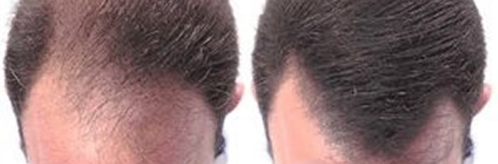 FUE before and after