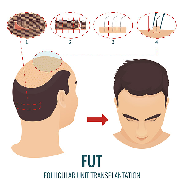 fut-hair-transplant-technique